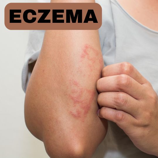 eczema