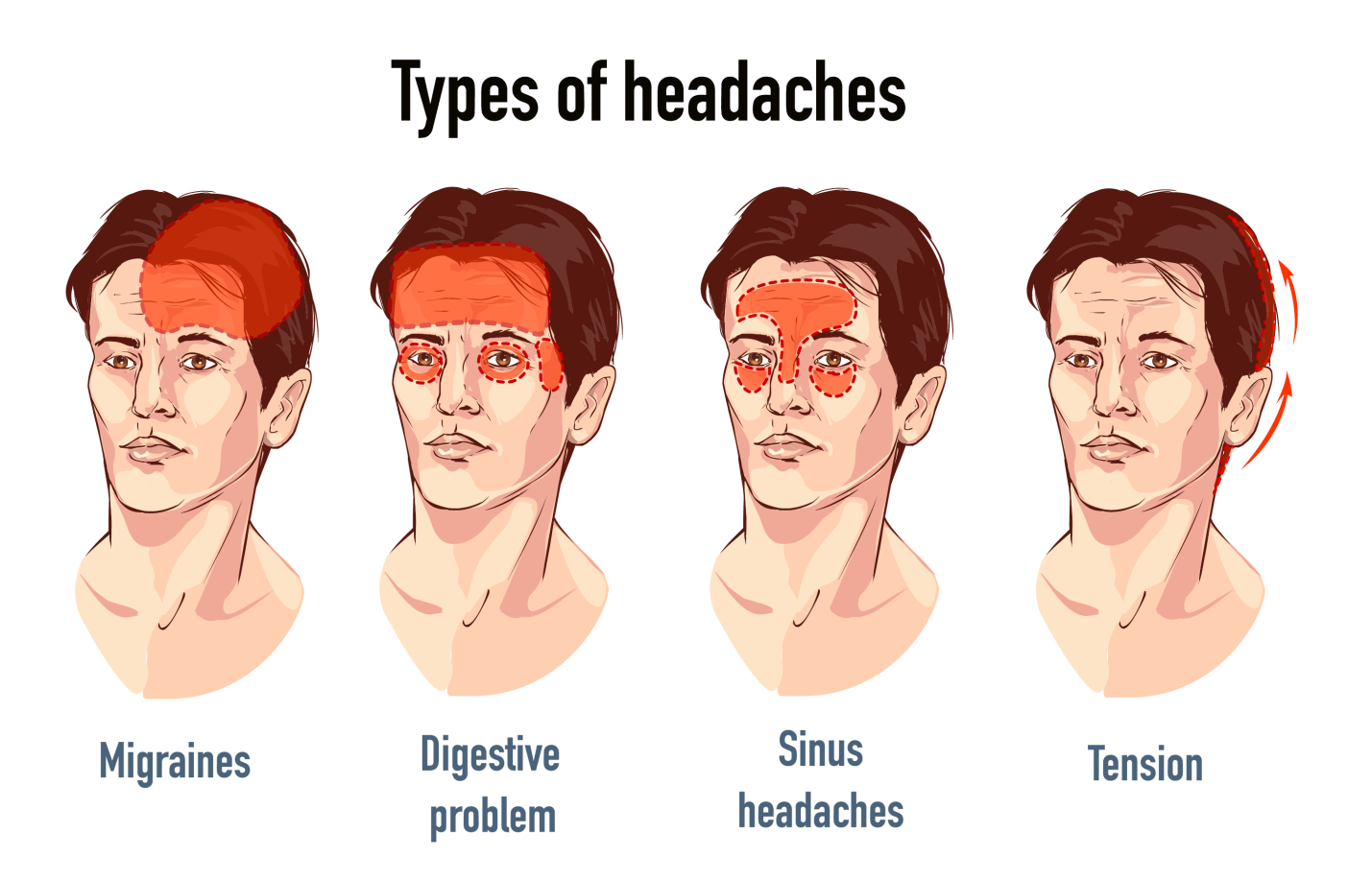 Types of Headaches: Symptoms, Causes And Treatment