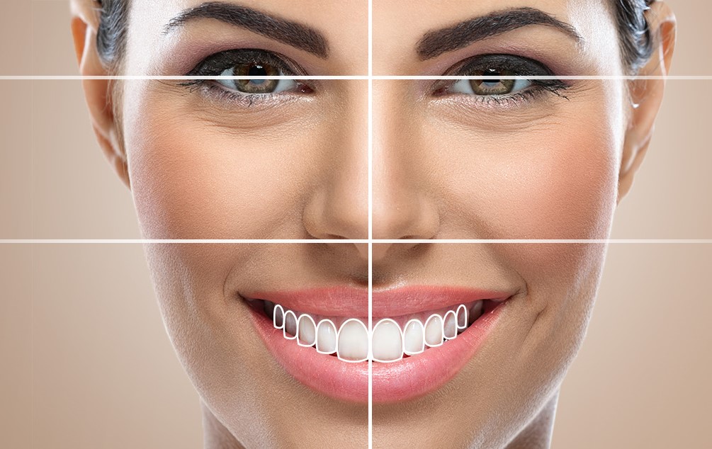 best smile designing in hyderabad