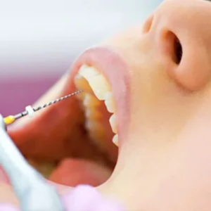 root canal treatment in karad