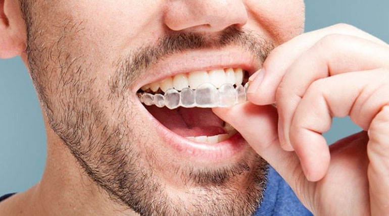 Best Invisalign in Navi Mumbai