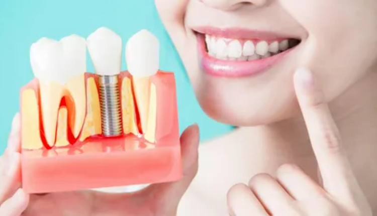 dental implants