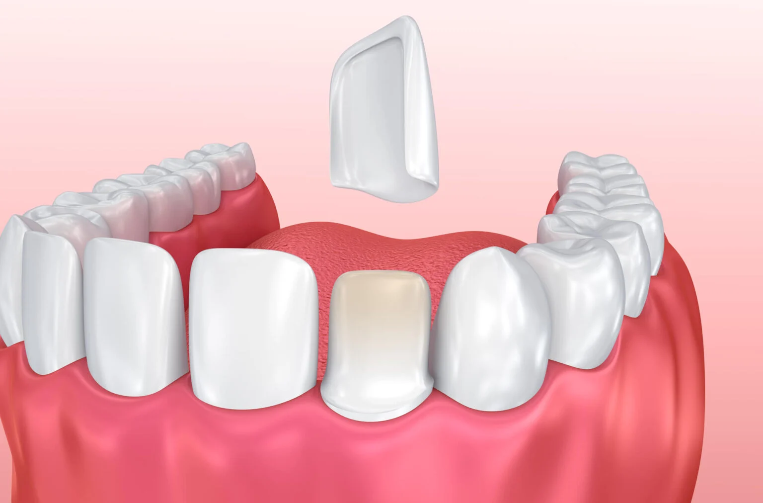 dental veneers in Nagpur