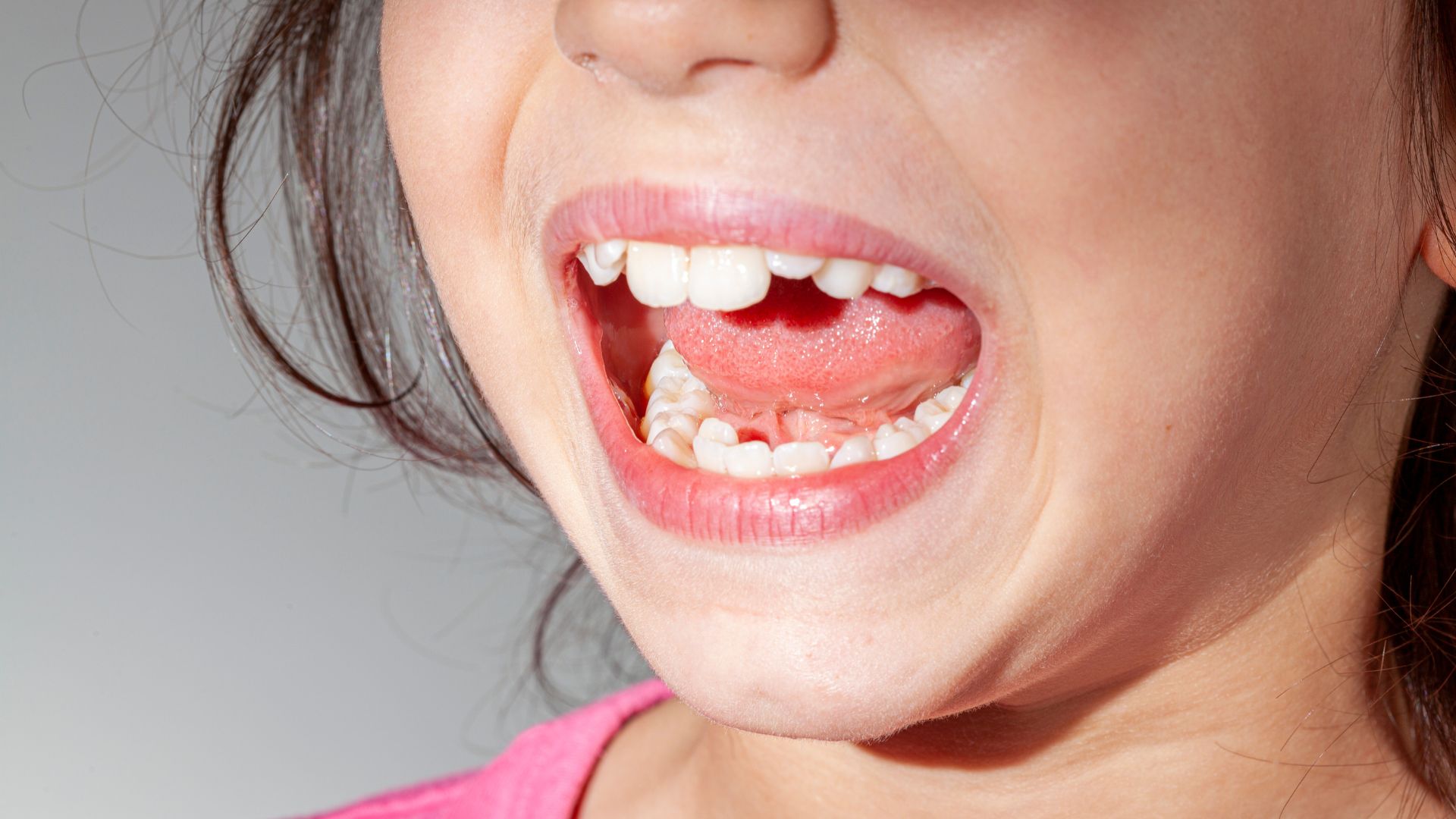 managing-crowded-teeth-through-invisalign