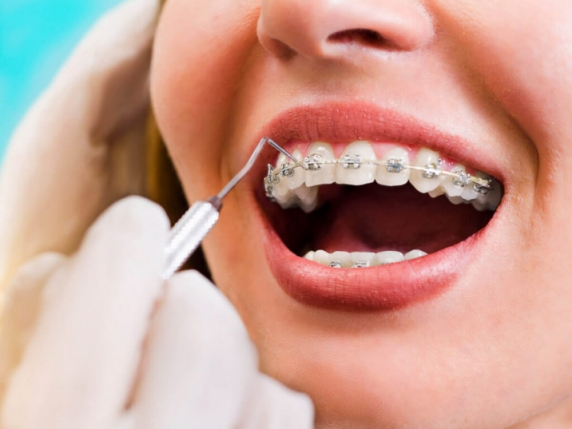 braces treatment in bhopal