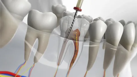 Root Canal Treatment