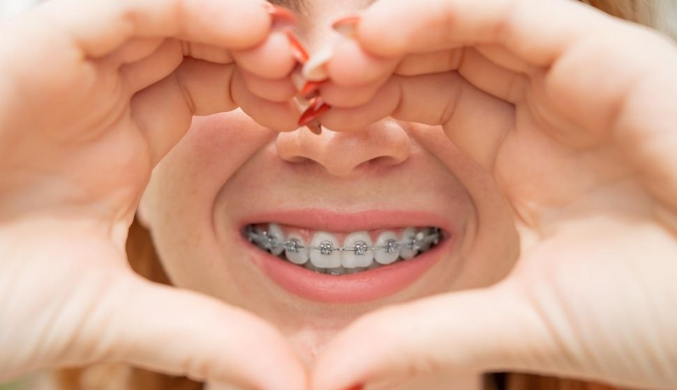 Braces Treatment In Goregaon