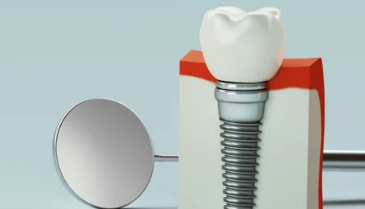 dental implants