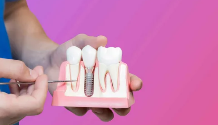 dental implants