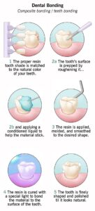 Dental Bonding