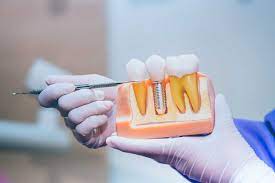 dental implant treatment in dombivli