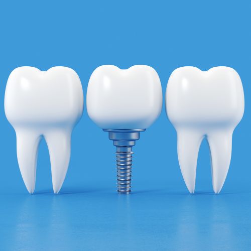 dental implants in rajajinagar