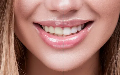 teeth whitening in sinhagad road