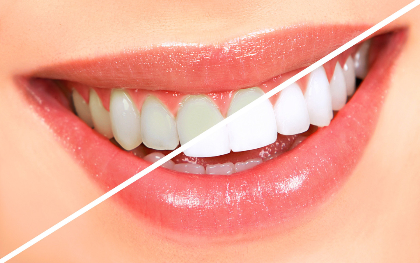 professional teeth whitening in oshiwara