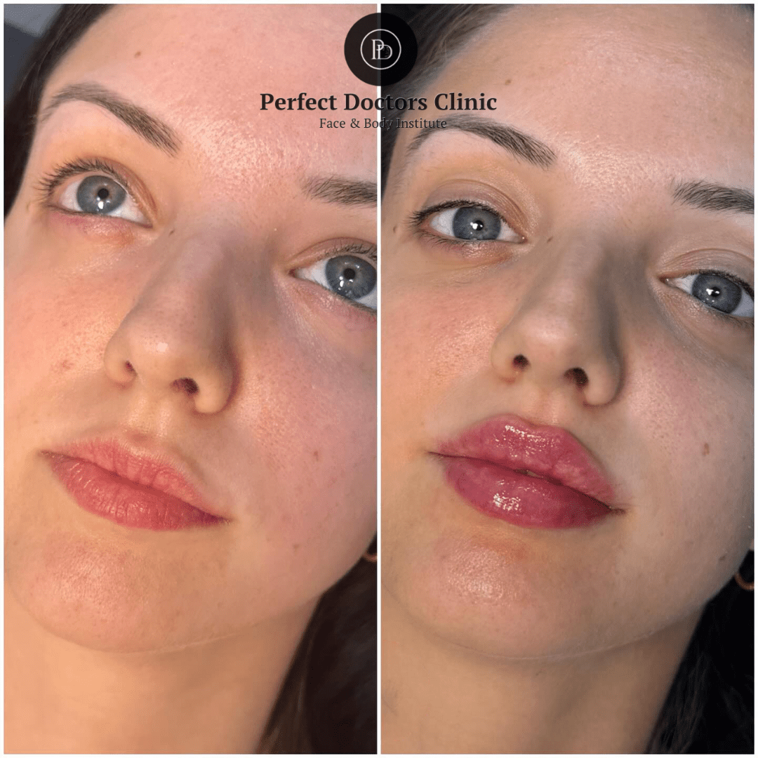 Juvederm in Dubai