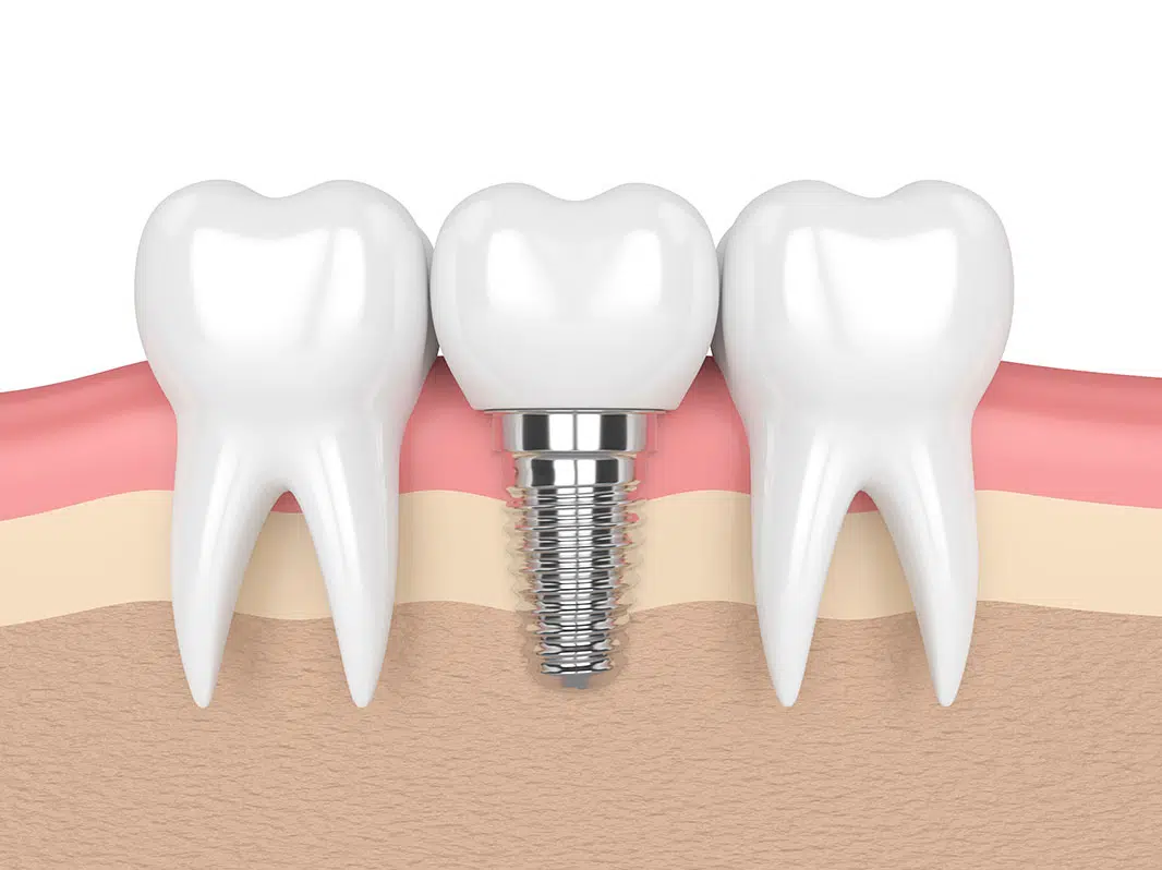 dental implants in matunga