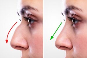 Rhinoplasty Surgery in Delhi