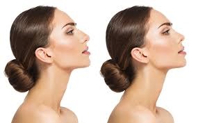 Rhinoplasty in Dubai