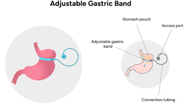 Bariatric, Bariatric surgeon, Delhi