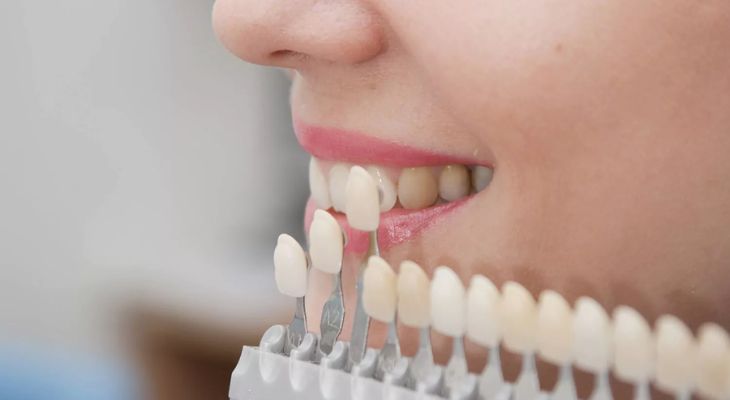 Dental Veneers in Delhi