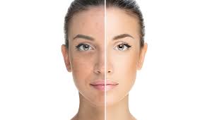 acne treatment in rajajinagar