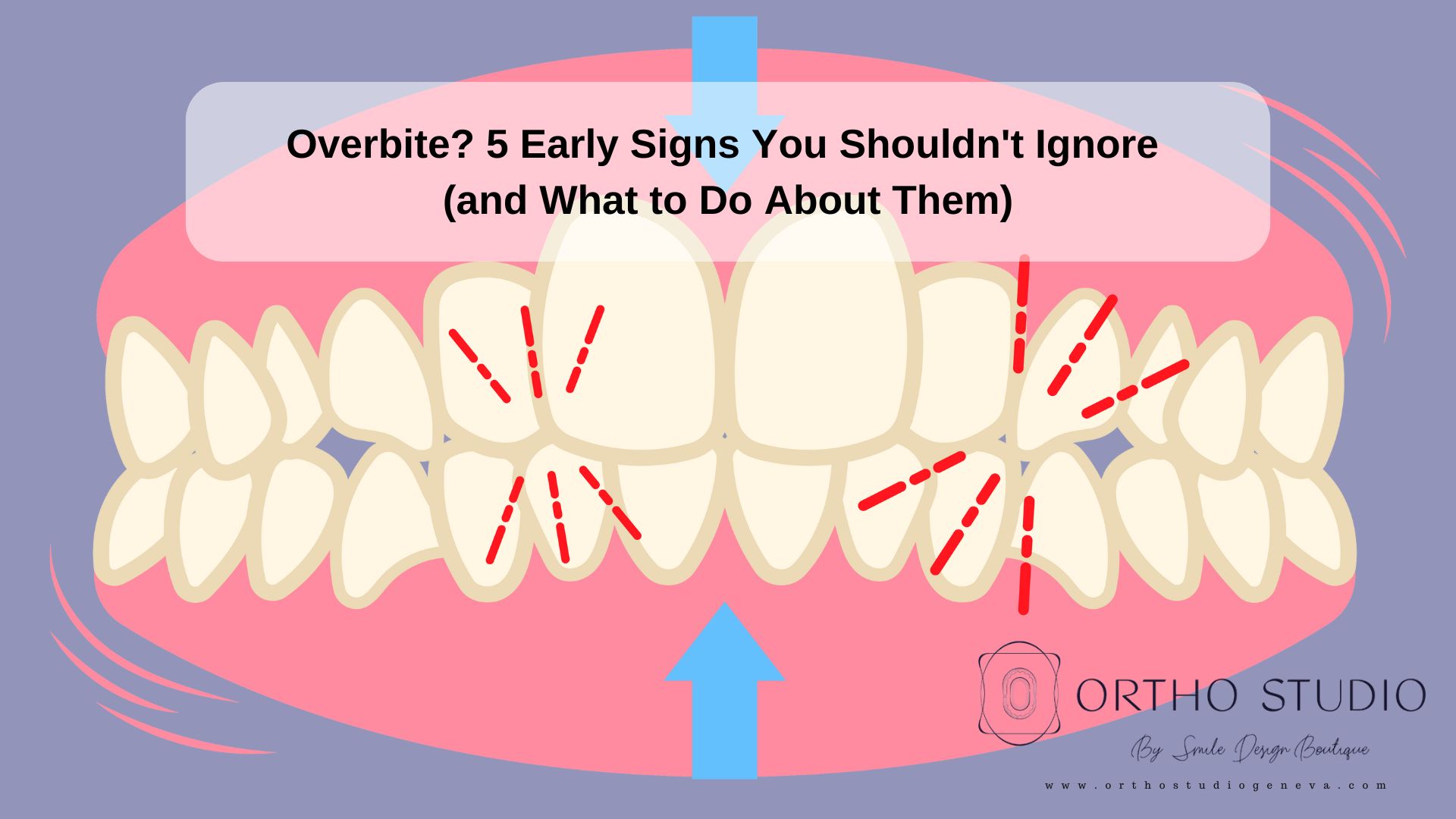 Overbite 5 Early Signs You Shouldn T Ignore And What To Do About Them Ezine Articles Overbite 5 Early Signs You Shouldn T Ignore And What To Do About Them Ezine Articles