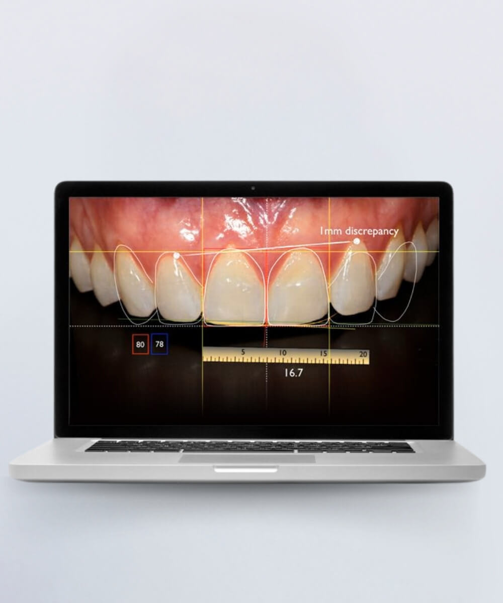 digital smile designing