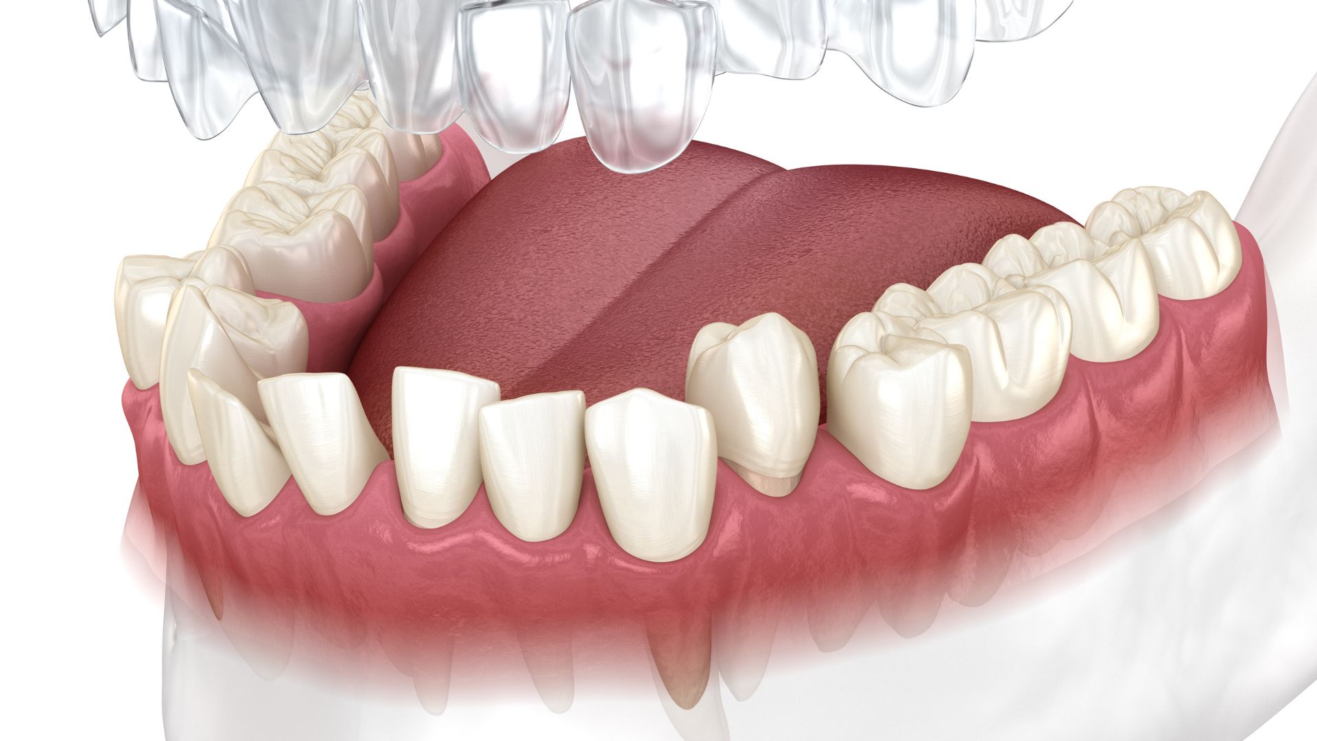 the-future-of-invisalign-new-innovations-and-technology