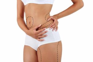 Tummy tuck surgery in Delhi