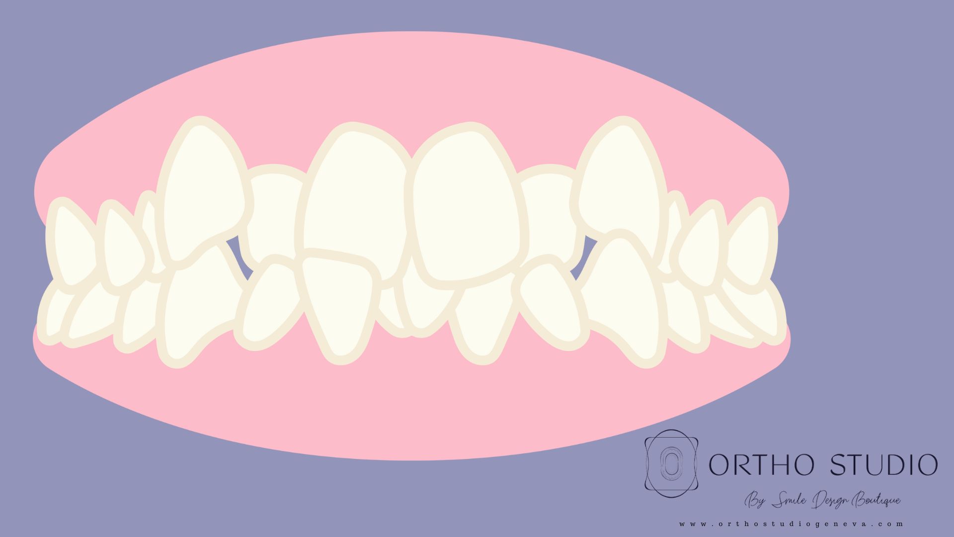 Overbite 5 Early Signs You Shouldn T Ignore And What To Do About Them Ezine Articles Overbite 5 Early Signs You Shouldn T Ignore And What To Do About Them Ezine Articles