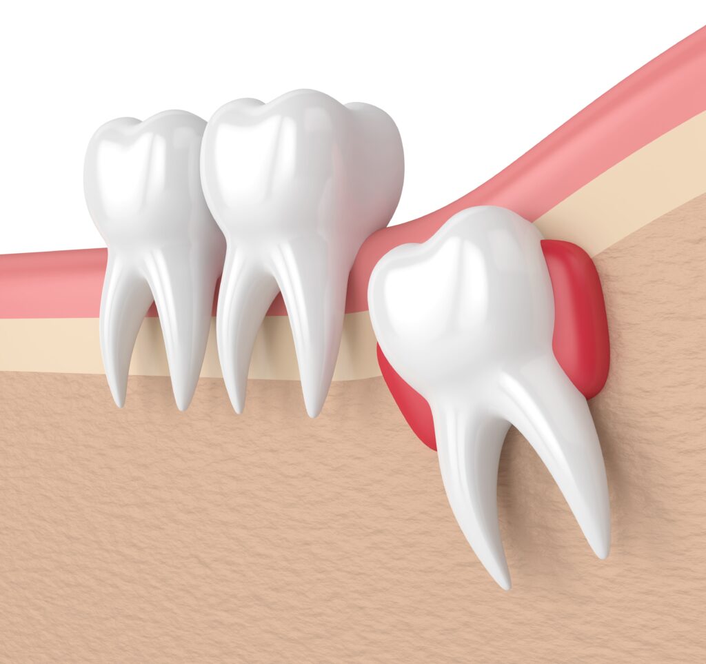 wisdom tooth removal in sambalpur