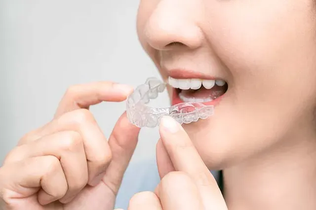 invisalign services in chesterfield