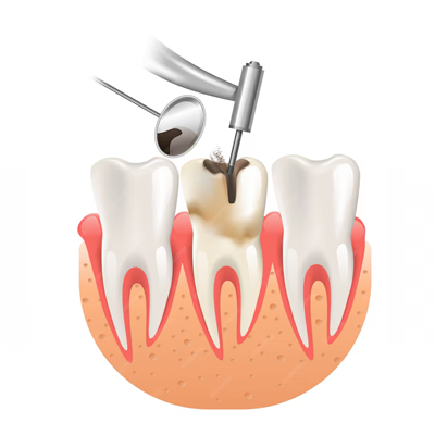Tooth Filling Cost in Kolathur Chennai