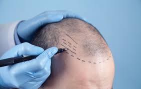 Hair Transplant Cost in Riyadh