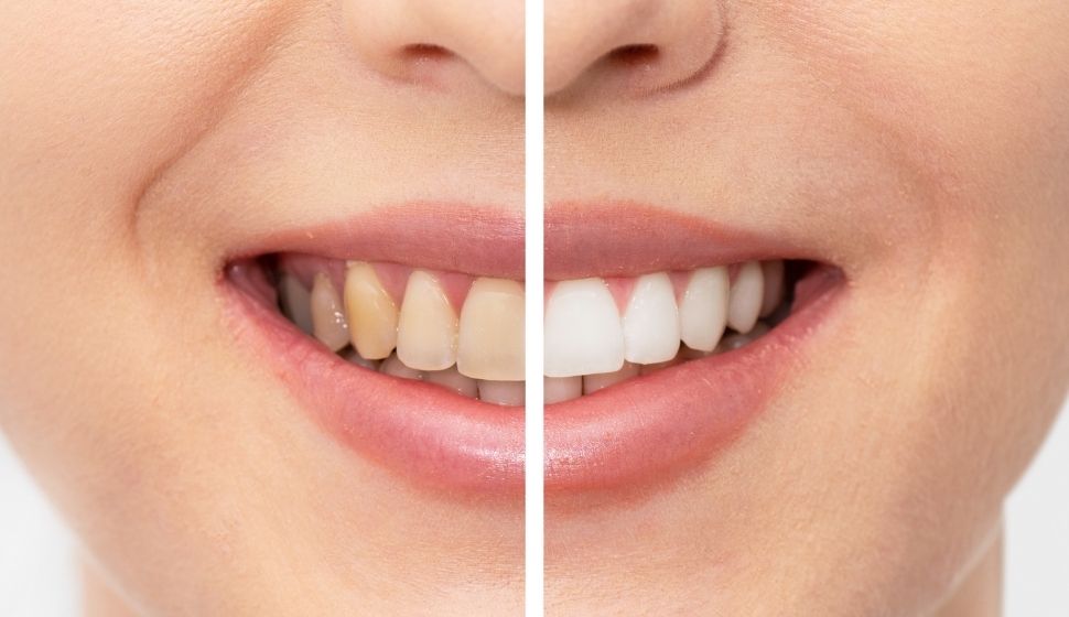 Teeth Whitening In Goregaon