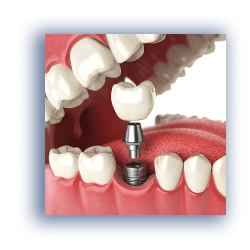 Tooth Implant in Kolathur, Chennai