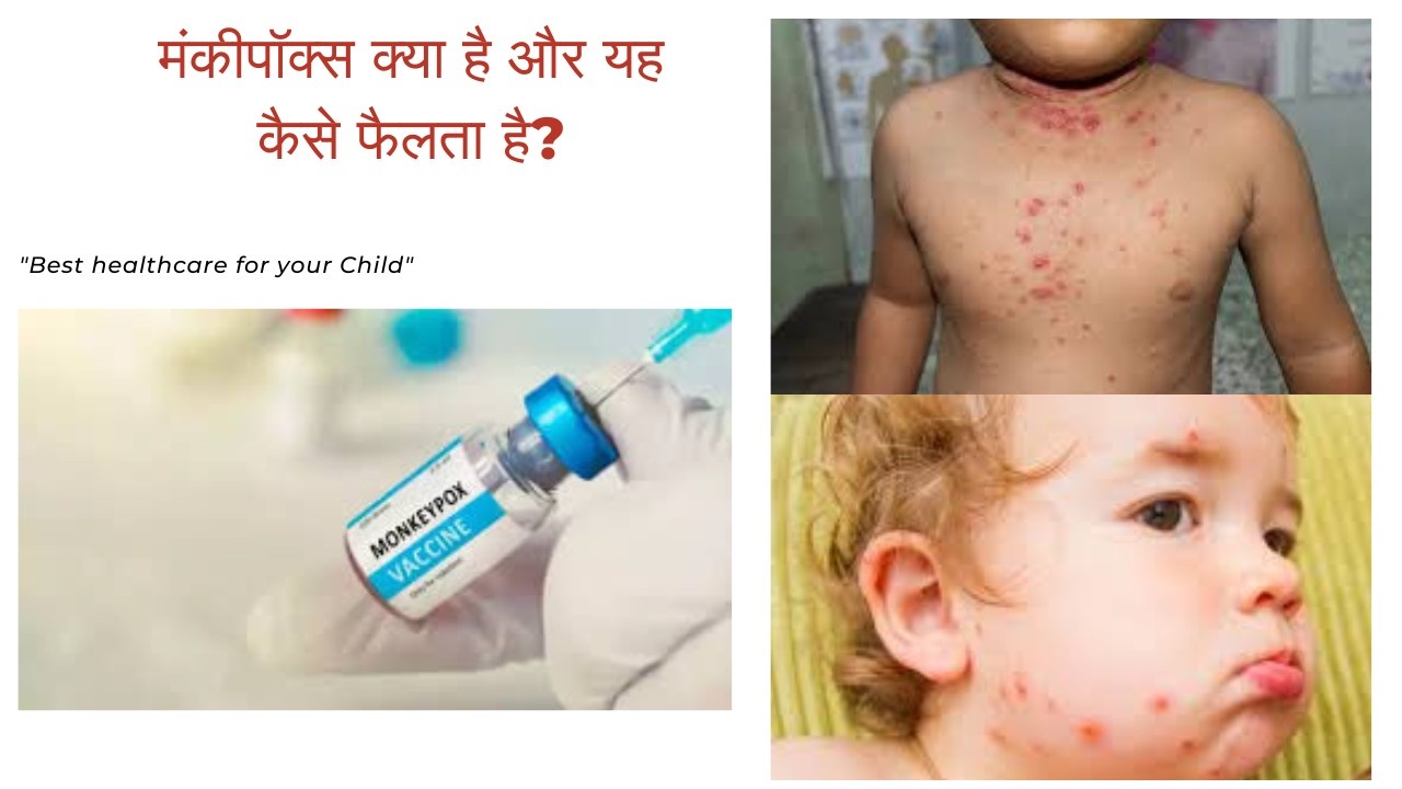 moneky pox in kids