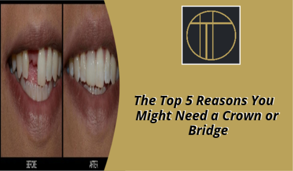 dental crowns and bridges