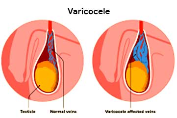Varicocele-Treatment-in-Hyderabad