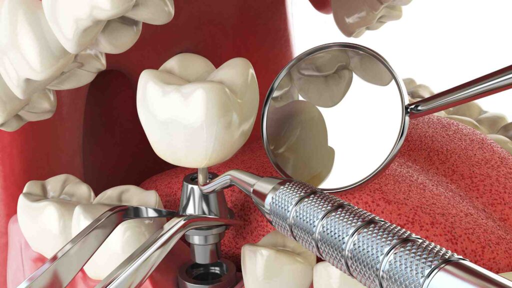 When-and-Why-to-Consider-Both-Braces-and-Dental-Implants