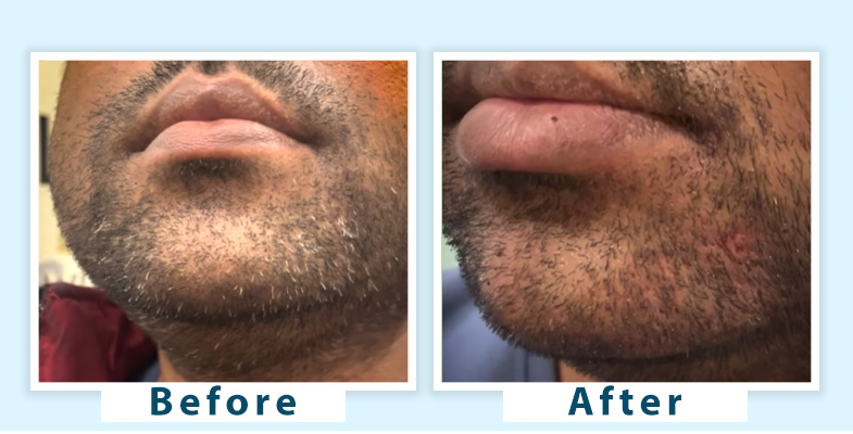 Man receiving grey beard treatment at a clinic, focusing on natural and professional solutions to restore beard color and maintain a youthful appearance.