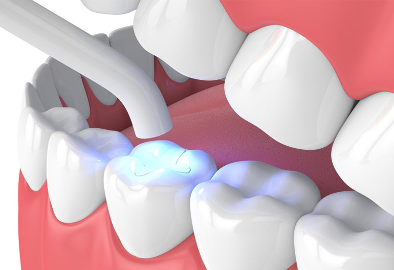 dental filling cost