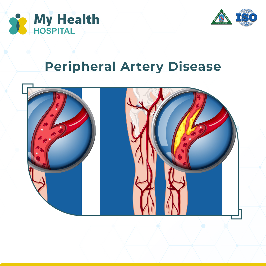 Peripheral-Artery-Disease