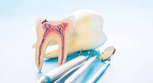 root canal treatment in dombivli