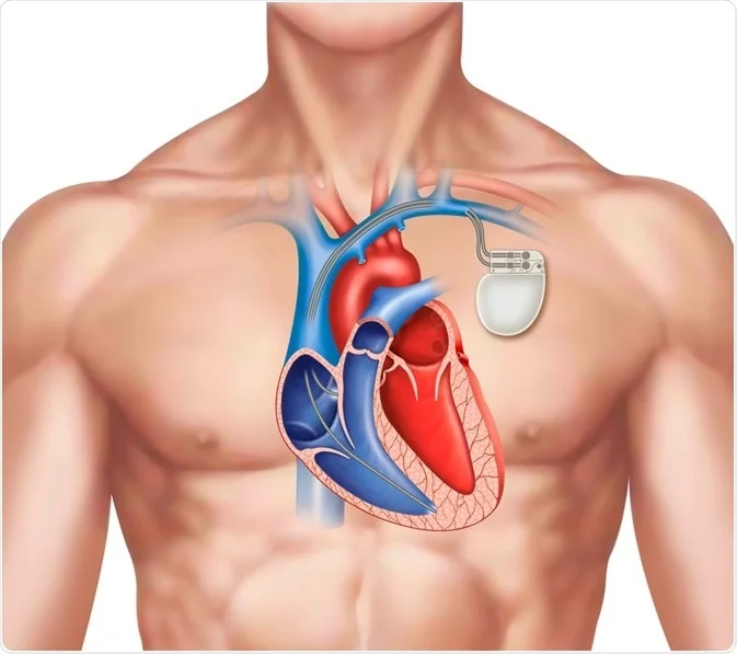 pacemaker implant