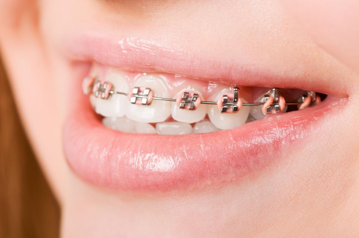 Achieving Hollywood Smiles Orthodontic Braces in Dubai