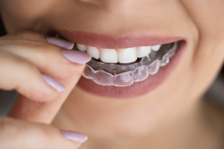 Do Aligners Work as Well as Braces An Honest Comparison