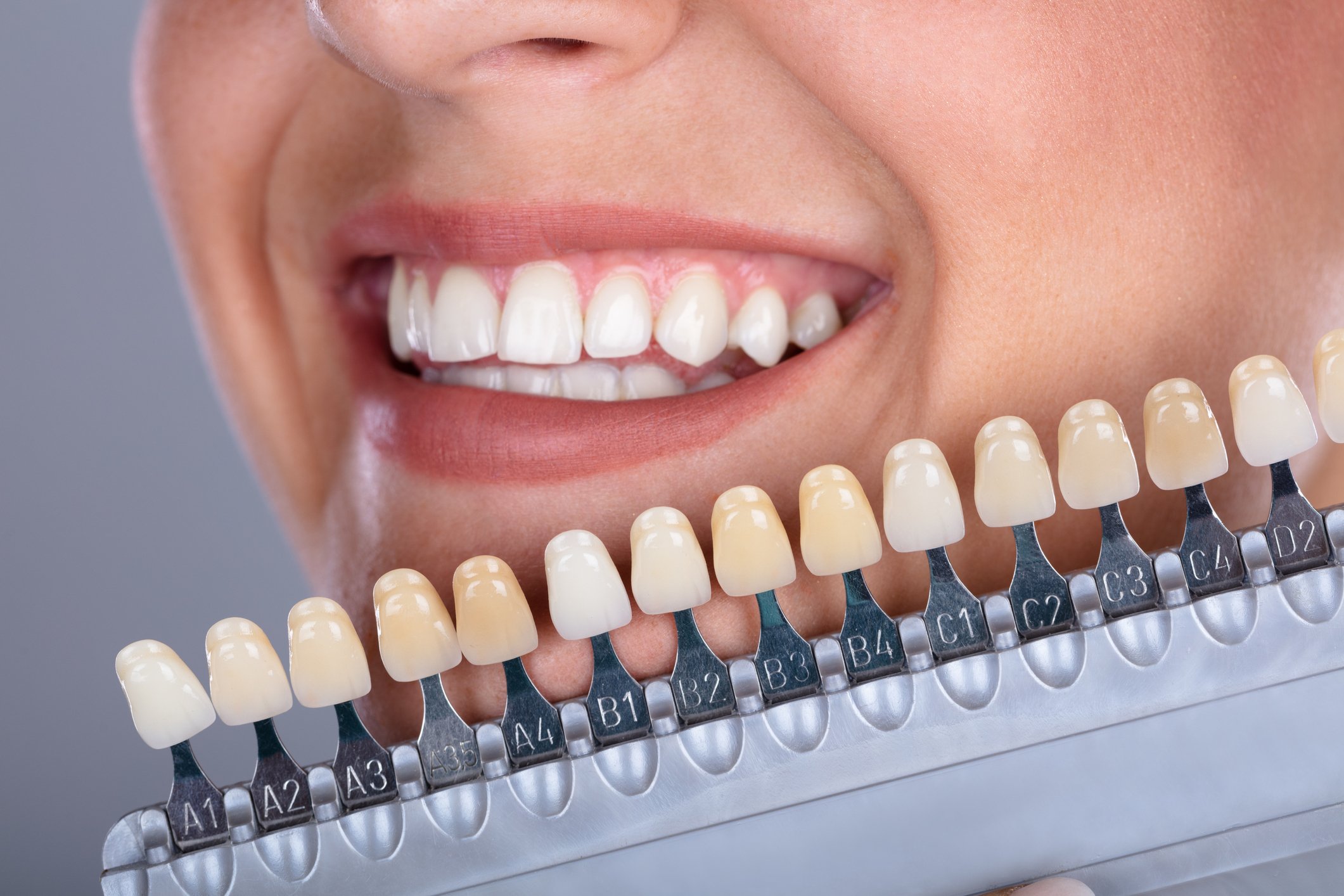 From Consultation to Completion Your Veneer Journey Explained