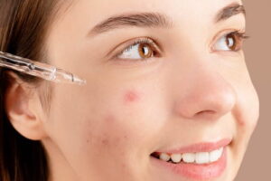 Pimple-Free for Life The Acne Treatment Plan That’s Right for You