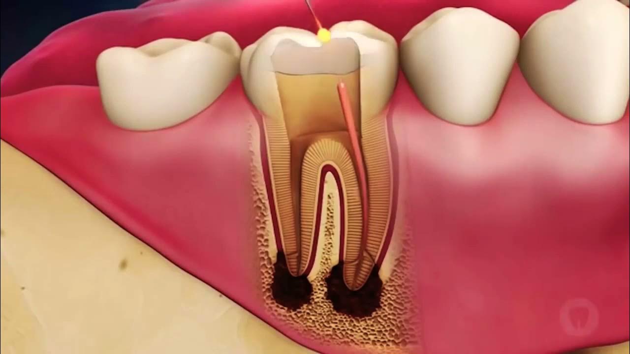 root canal treatment in hinjewadi